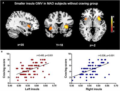 Structural Imaging-Based Biomarkers for Detecting Craving and Predicting Relapse in Subjects With Methamphetamine Dependence